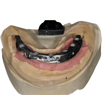 Hybrid Implant Hybrid Implant