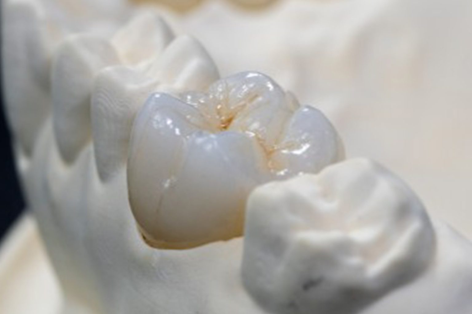 SDS Fixed Restoration Full Zirconia