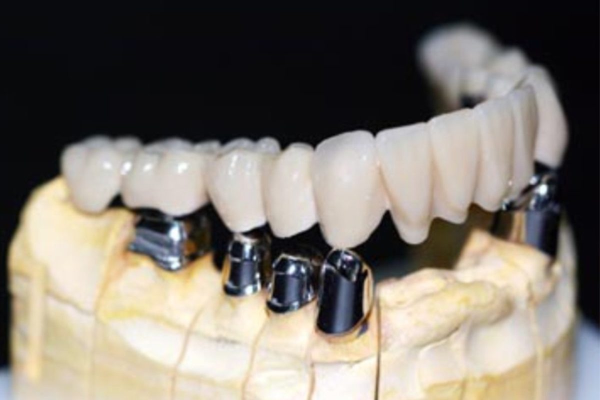 Custom Abutment Design Workflow: What Dental Labs Should Check From Scanbody to Final Approval Custom Abutment Design Workflow: What Dental Labs Should Check From Scanbody to Final Approval