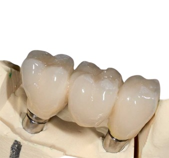 SDS Implant Bridge