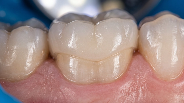 finished dental crown restoration fitted on a prepared tooth